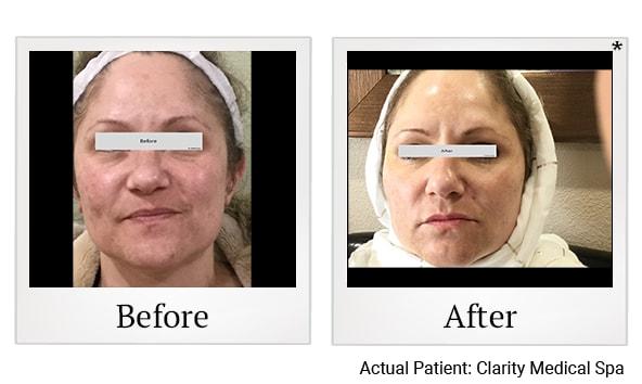 Clarity Medical Spa - San Jose, Berryessa | PRP Hair Restoration, Injectables, Fillers, EZGel, Microneedling & Weight Loss laser treatment result — San Jose, CA