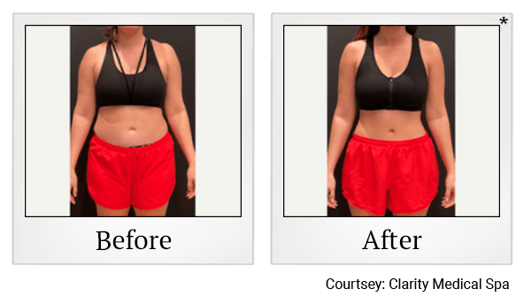 Clarity Medical Spa - San Jose, Berryessa | PRP Hair Restoration, Injectables, Fillers, EZGel, Microneedling & Weight Loss microneedling result — San Jose, CA