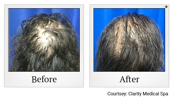 Microneedling result at Clarity Medical Spa - San Jose, Berryessa | PRP Hair Restoration, Injectables, Fillers, EZGel, Microneedling & Weight Loss in San Jose, CA