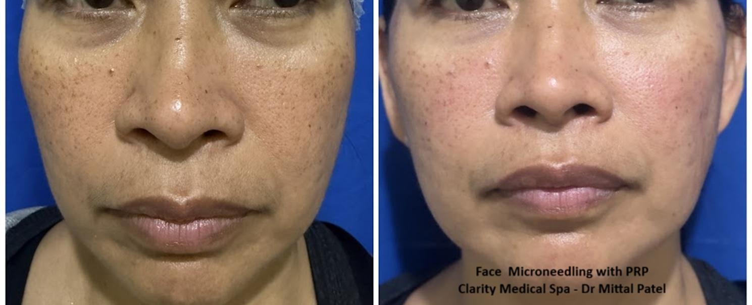 Clarity Medical Spa - San Jose, Berryessa | PRP Hair Restoration, Injectables, Fillers, EZGel, Microneedling & Weight Loss microneedling result — San Jose, CA