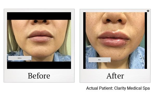 Clarity Medical Spa - San Jose, Berryessa | PRP Hair Restoration, Injectables, Fillers, EZGel, Microneedling & Weight Loss lip filler result — San Jose, CA