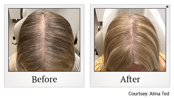 Clarity Medical Spa - San Jose, Berryessa | PRP Hair Restoration, Injectables, Fillers, EZGel, Microneedling & Weight Loss microneedling result — San Jose, CA