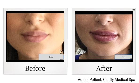 Clarity Medical Spa - San Jose, Berryessa | PRP Hair Restoration, Injectables, Fillers, EZGel, Microneedling & Weight Loss lip filler result — San Jose, CA