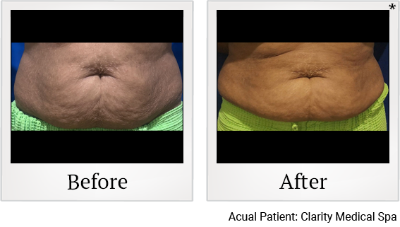 Clarity Medical Spa - San Jose, Berryessa | PRP Hair Restoration, Injectables, Fillers, EZGel, Microneedling & Weight Loss tummy tuck result — San Jose, CA