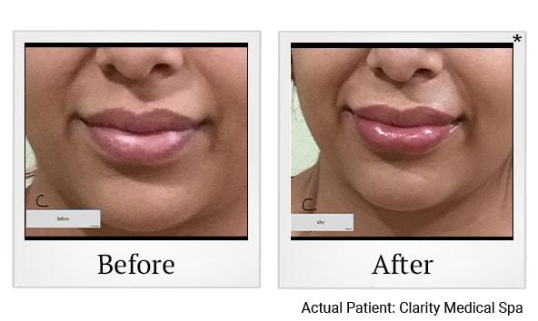 Clarity Medical Spa - San Jose, Berryessa | PRP Hair Restoration, Injectables, Fillers, EZGel, Microneedling & Weight Loss lip filler result — San Jose, CA