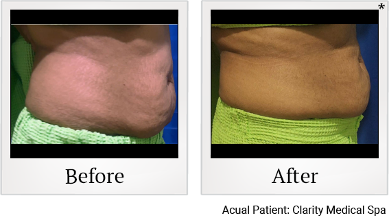 Tummy Tuck result at Clarity Medical Spa - San Jose, Berryessa | PRP Hair Restoration, Injectables, Fillers, EZGel, Microneedling & Weight Loss in San Jose, CA