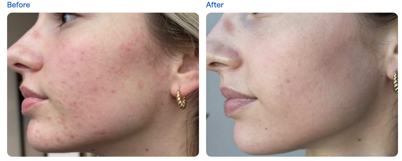 Clarity Medical Spa - San Jose, Berryessa | PRP Hair Restoration, Injectables, Fillers, EZGel, Microneedling & Weight Loss microneedling result — San Jose, CA