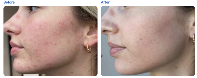 Microneedling result at Clarity Medical Spa - San Jose, Berryessa | PRP Hair Restoration, Injectables, Fillers, EZGel, Microneedling & Weight Loss in San Jose, CA