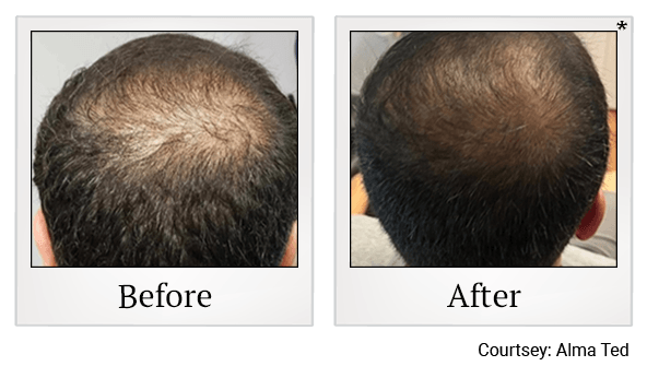 Clarity Medical Spa - San Jose, Berryessa | PRP Hair Restoration, Injectables, Fillers, EZGel, Microneedling & Weight Loss microneedling result — San Jose, CA