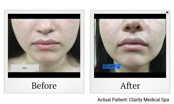 Clarity Medical Spa - San Jose, Berryessa | PRP Hair Restoration, Injectables, Fillers, EZGel, Microneedling & Weight Loss lip filler result — San Jose, CA