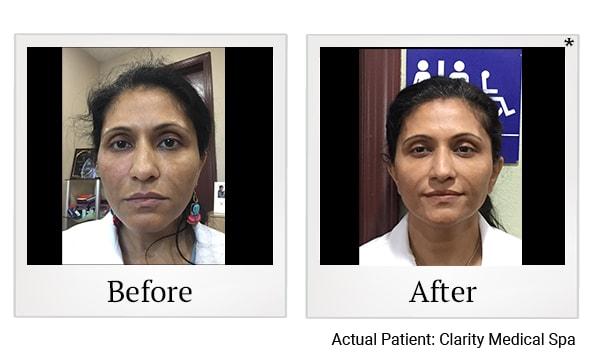 Clarity Medical Spa - San Jose, Berryessa | PRP Hair Restoration, Injectables, Fillers, EZGel, Microneedling & Weight Loss laser treatment result — San Jose, CA