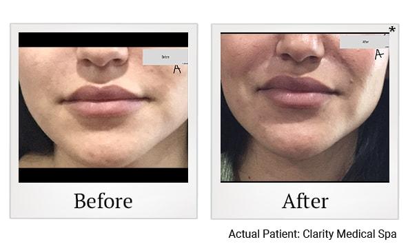 Clarity Medical Spa - San Jose, Berryessa | PRP Hair Restoration, Injectables, Fillers, EZGel, Microneedling & Weight Loss lip filler result — San Jose, CA