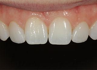 Smile Makeover after at David Wickness, DMD- Nashville Cosmetic Dentist in Nashville, TN