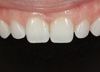 Smile Makeover before at David Wickness, DMD- Nashville Cosmetic Dentist in Nashville, TN