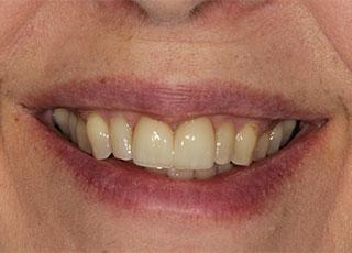 Smile Makeover after at David Wickness, DMD- Nashville Cosmetic Dentist in Nashville, TN