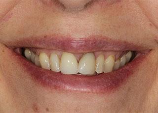 Smile Makeover before at David Wickness, DMD- Nashville Cosmetic Dentist in Nashville, TN