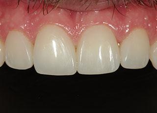 David Wickness, DMD- Nashville Cosmetic Dentist smile makeover after — Nashville, TN
