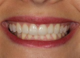 David Wickness, DMD- Nashville Cosmetic Dentist smile makeover after — Nashville, TN