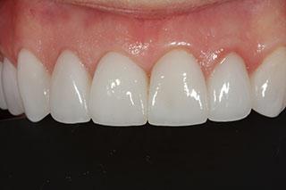 David Wickness, DMD- Nashville Cosmetic Dentist smile makeover after — Nashville, TN