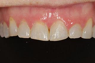 Smile Makeover before at David Wickness, DMD- Nashville Cosmetic Dentist in Nashville, TN