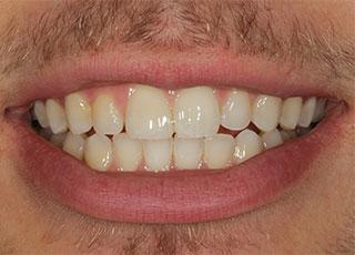 Smile Makeover after at David Wickness, DMD- Nashville Cosmetic Dentist in Nashville, TN