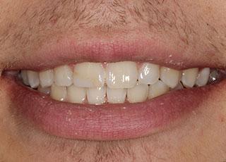Smile Makeover before at David Wickness, DMD- Nashville Cosmetic Dentist in Nashville, TN