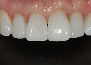 Smile Makeover after at David Wickness, DMD- Nashville Cosmetic Dentist in Nashville, TN