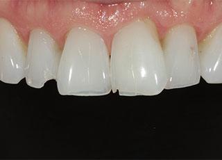 Smile Makeover before at David Wickness, DMD- Nashville Cosmetic Dentist in Nashville, TN