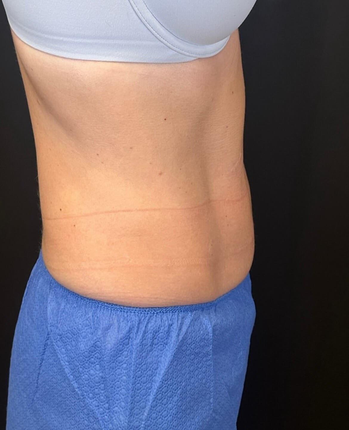 JEM MedSpa emsculpt after — Elmhurst, IL