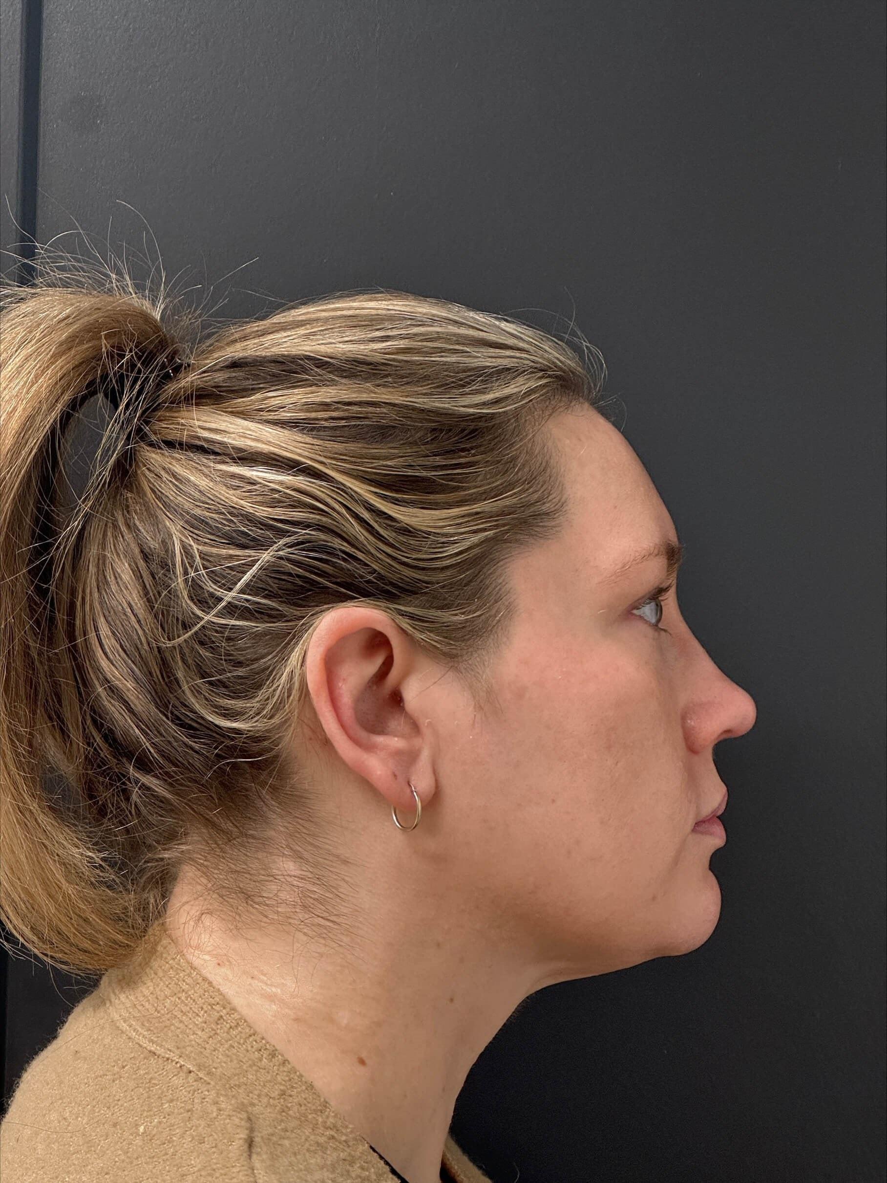 JEM MedSpa double chin treatment after — Elmhurst, IL