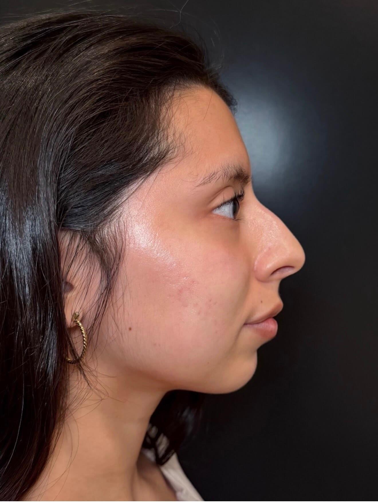 JEM MedSpa microneedling after — Elmhurst, IL
