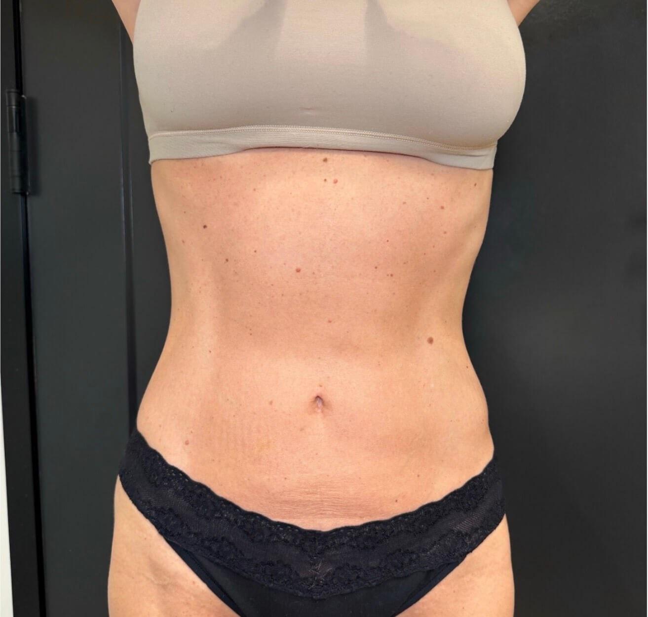 JEM MedSpa emsculpt after — Elmhurst, IL