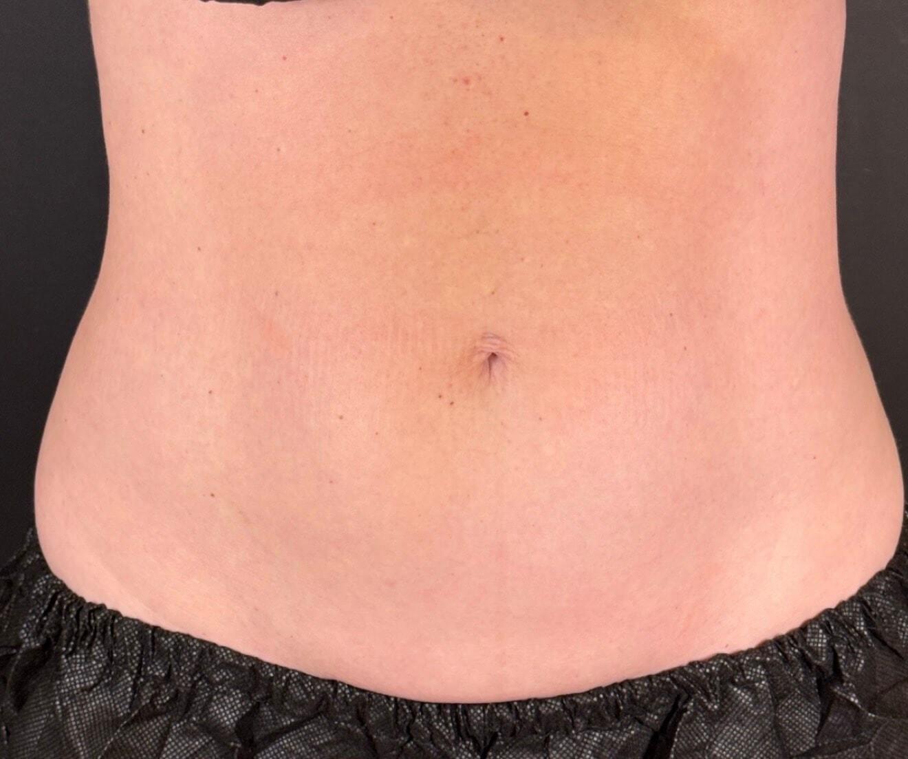 JEM MedSpa fat freezing after — Elmhurst, IL