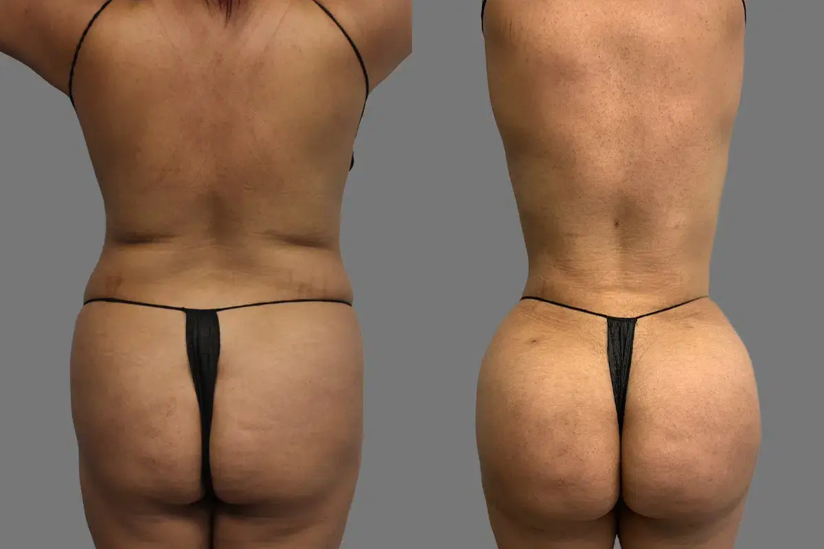 Mia Aesthetics liposuction result — Miami, FL