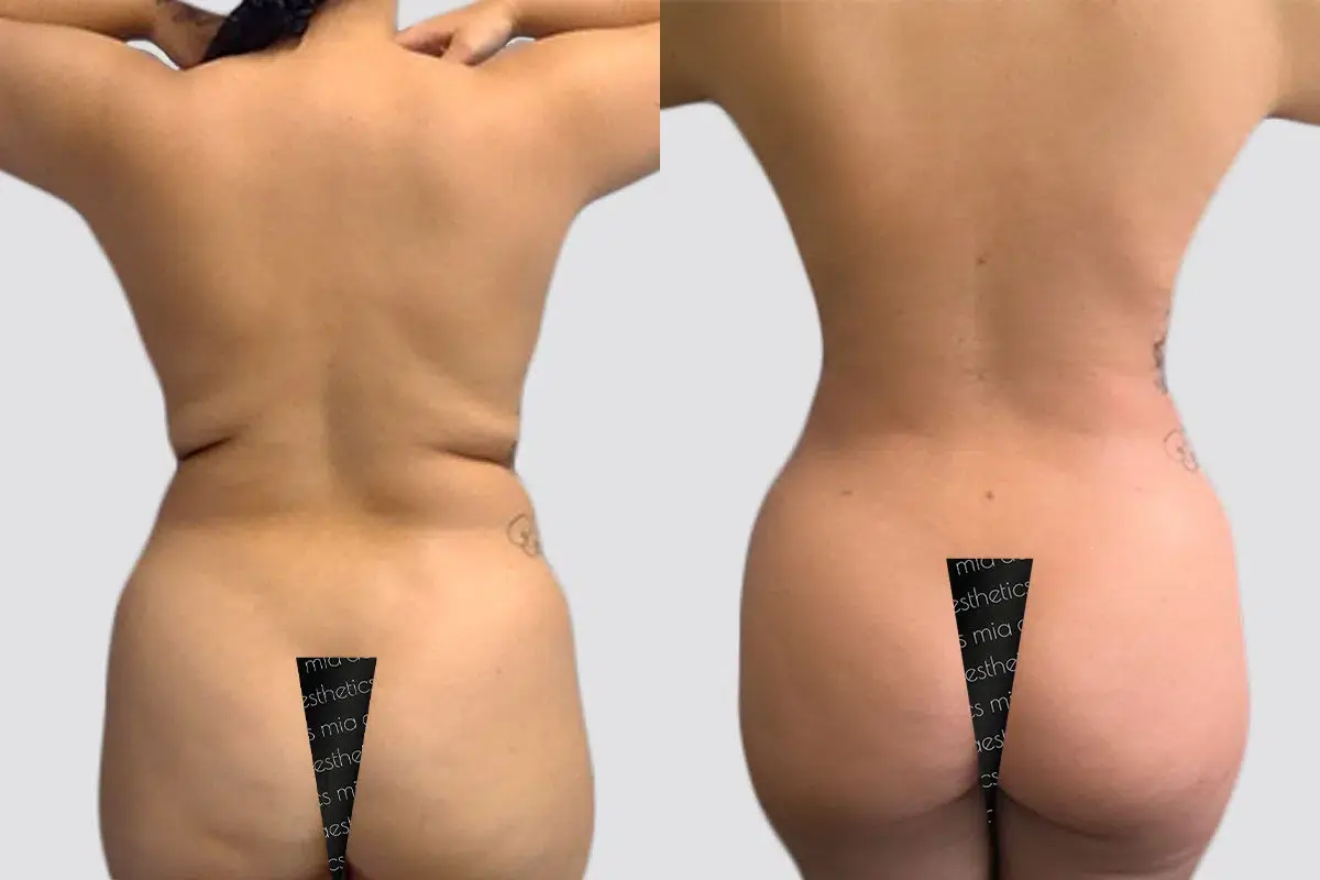 Mia Aesthetics liposuction result — Miami, FL