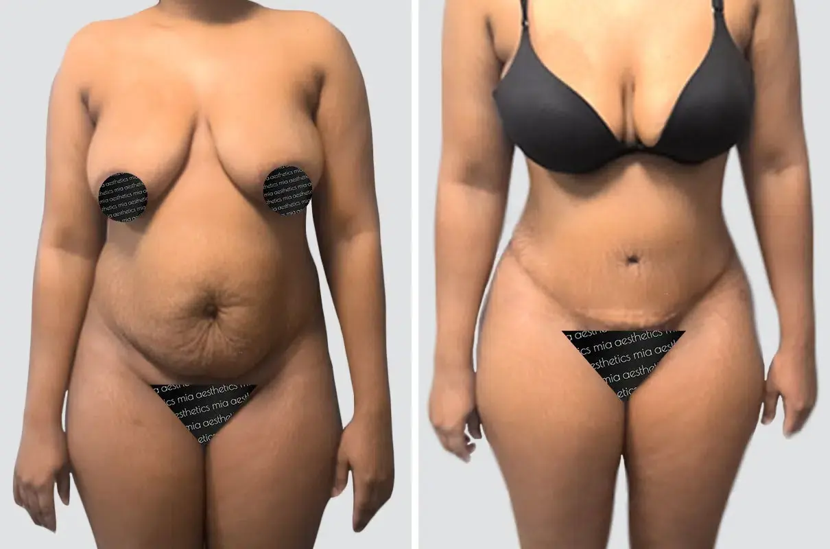 Mia Aesthetics tummy tuck result — Miami, FL