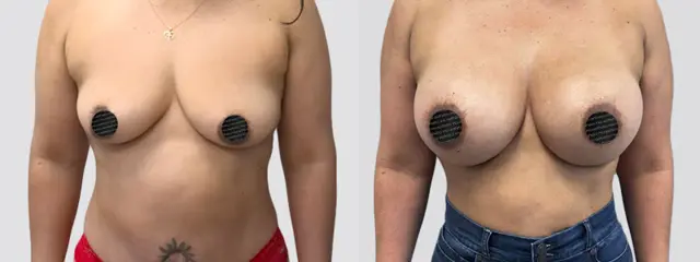 Fat Transfer Breast Augmentation result at Mia Aesthetics in Miami, FL