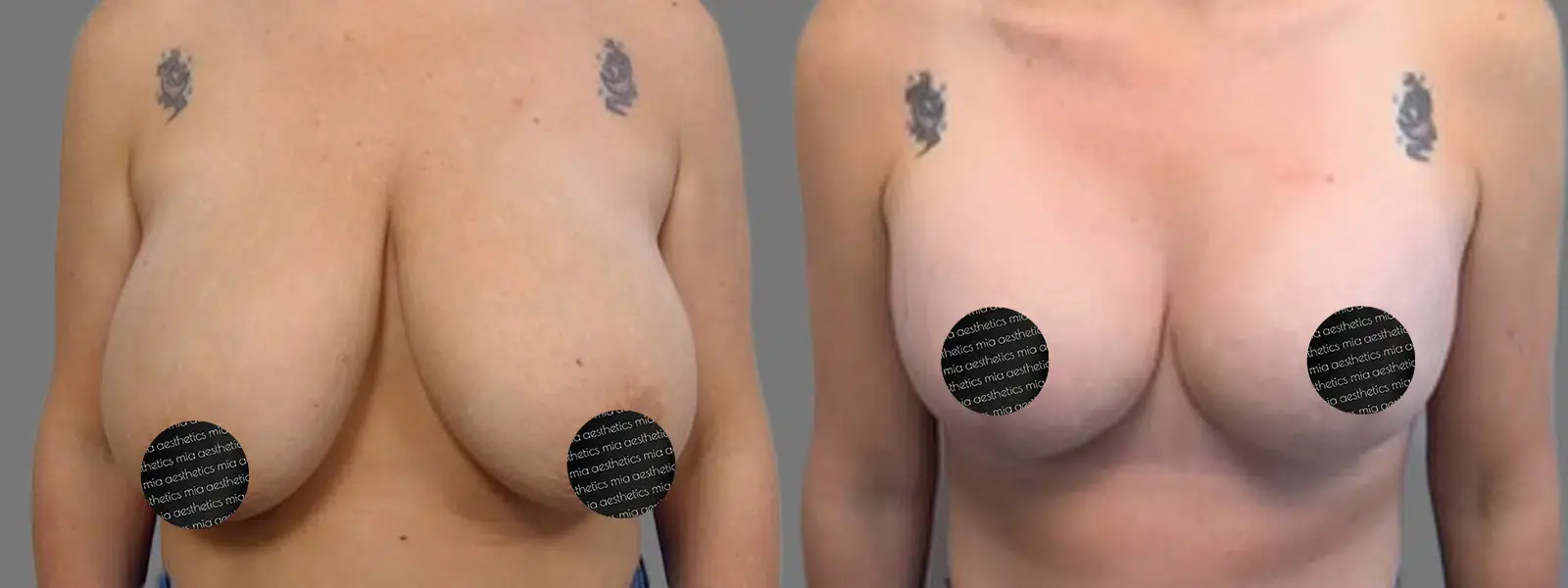 Mia Aesthetics breast lift result — Miami, FL