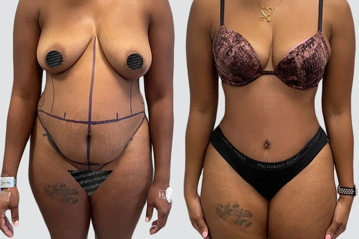 Mia Aesthetics tummy tuck result — Miami, FL