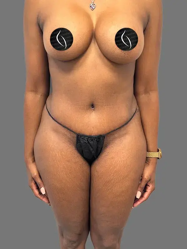 Mia Aesthetics tummy tuck after — Miami, FL
