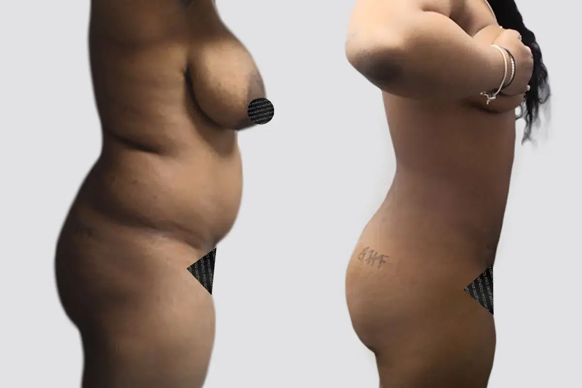 Mia Aesthetics liposuction result — Miami, FL