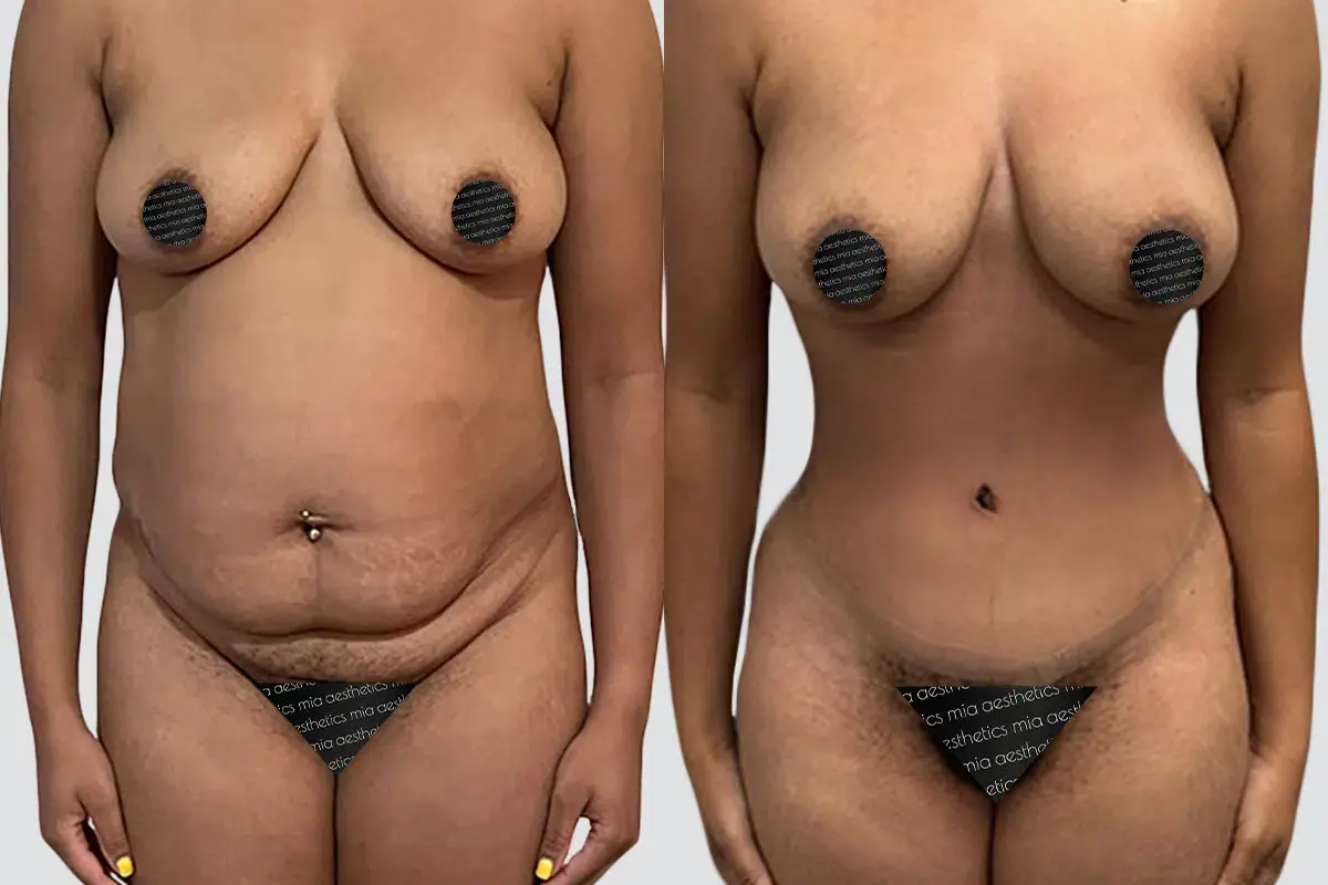 Mia Aesthetics tummy tuck result — Miami, FL