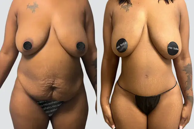 Tummy Tuck result at Mia Aesthetics in Miami, FL