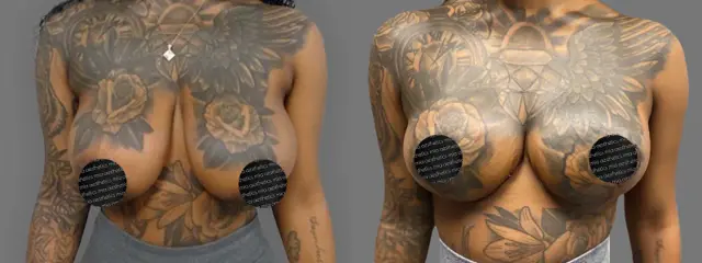 Breast Reduction result at Mia Aesthetics in Miami, FL
