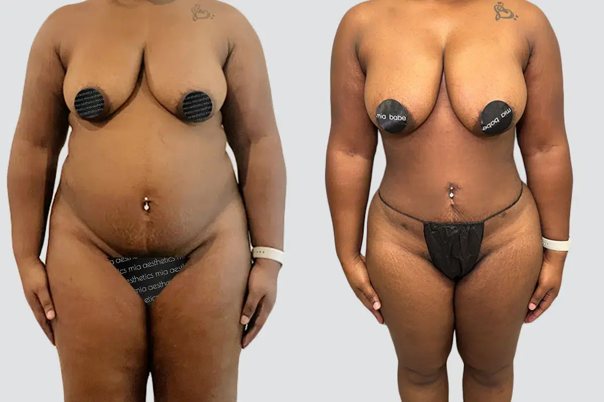 Mia Aesthetics liposuction result — Miami, FL