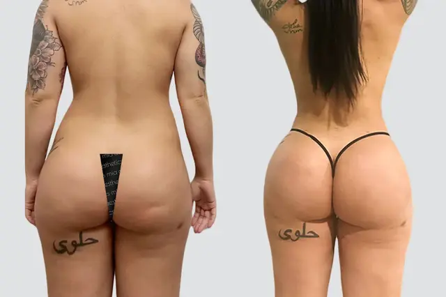 Brazilian Butt Lift result at Mia Aesthetics in Miami, FL