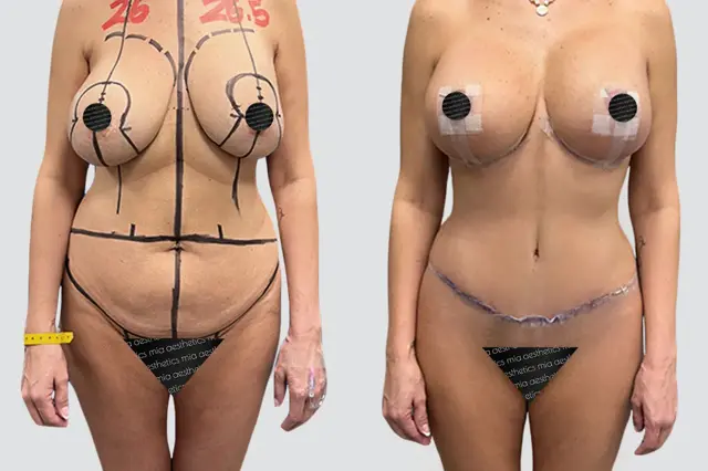 Mommy Makeover result at Mia Aesthetics in Miami, FL