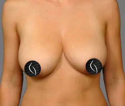 Breast Lift before at Mia Aesthetics in Miami, FL