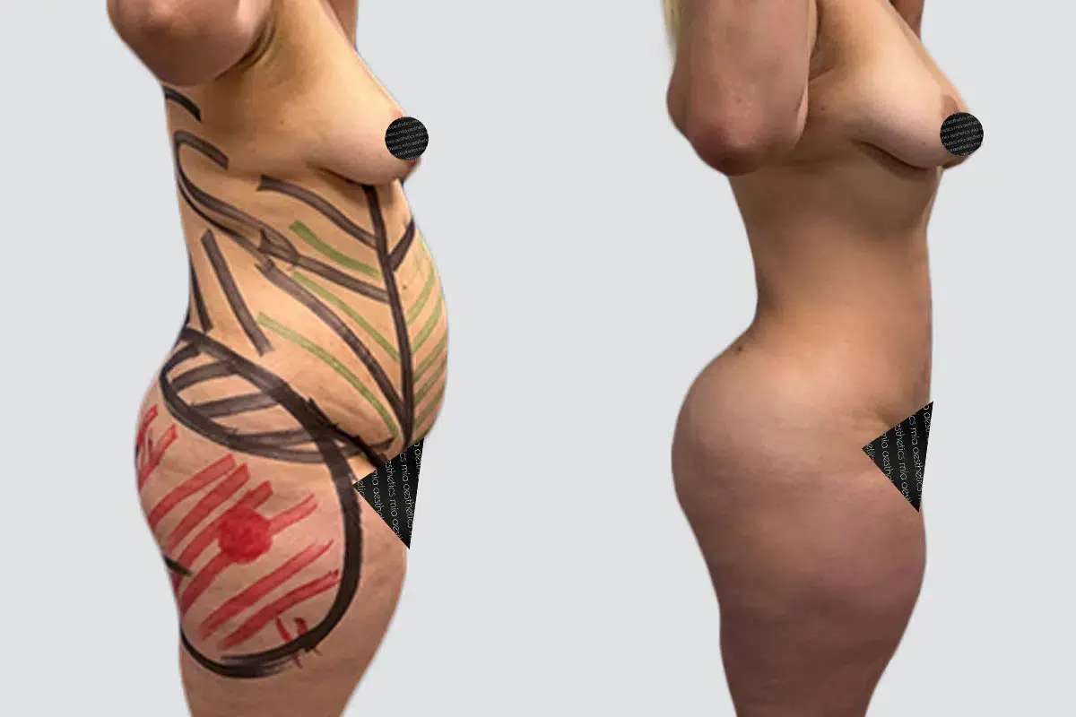 Mia Aesthetics liposuction result — Miami, FL