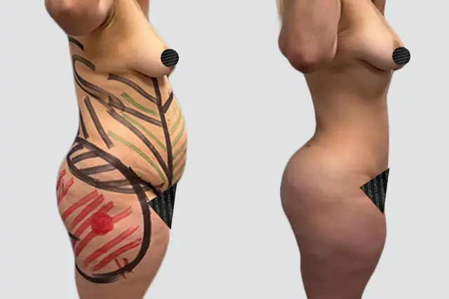 Liposuction result at Mia Aesthetics in Miami, FL